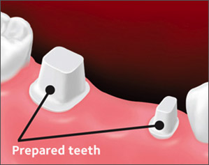 Teeth next to the gap are prepared for placement of the bridge